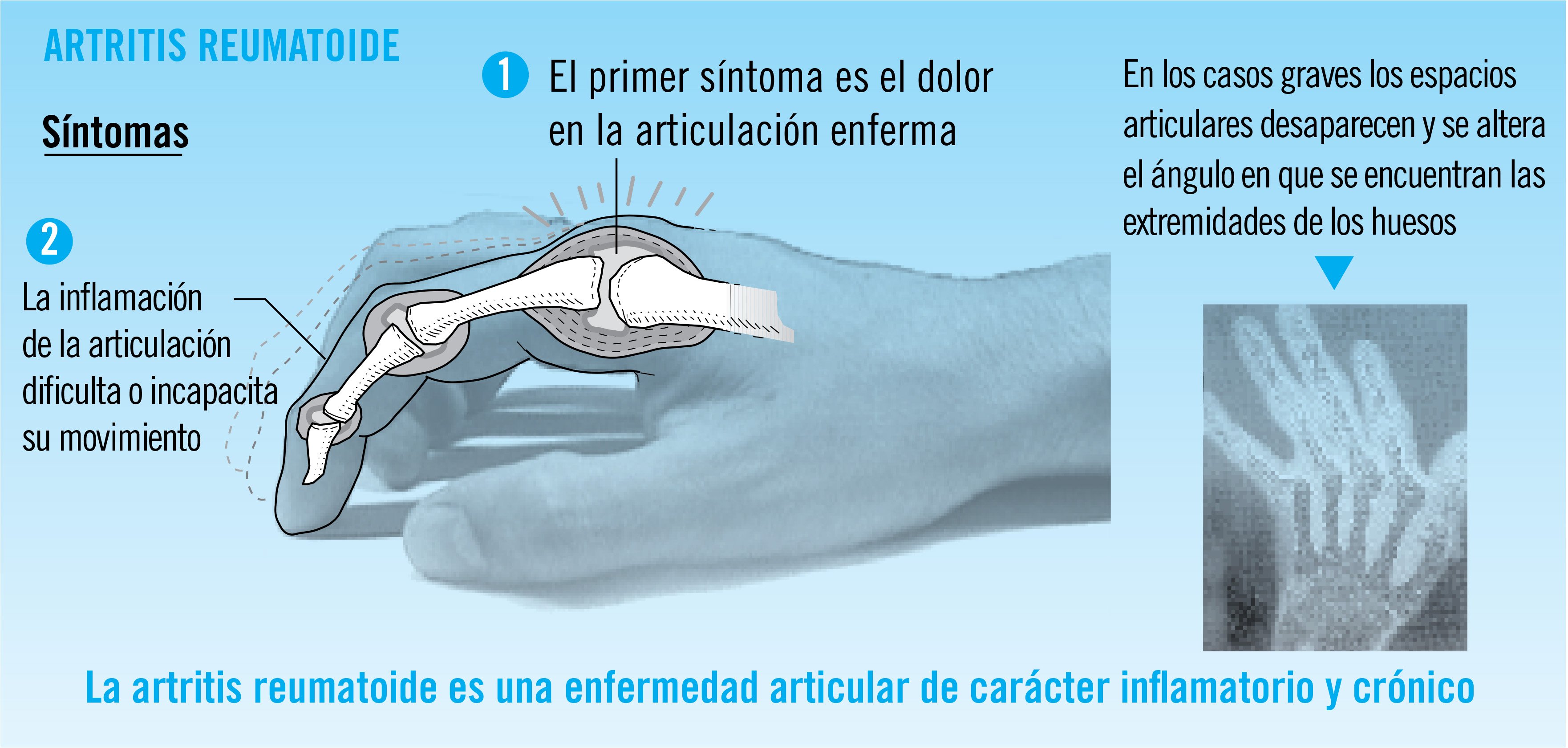 artritis-reumatoide-infografia